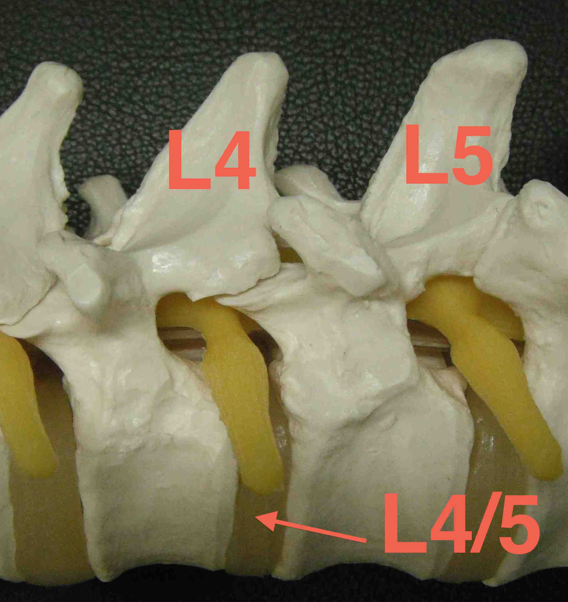 Lumbar Intervertebral Foramen